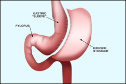 Bariatric Surgery