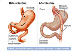 Biliopancreatic diversion