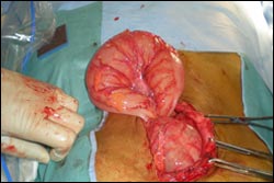 Colorectal Surgery