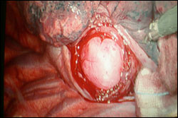 Esophageal Cancer Surgery