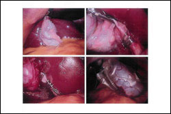 Gall Bladder and Biliary Tract Surgery