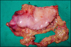 Gastric Surgery