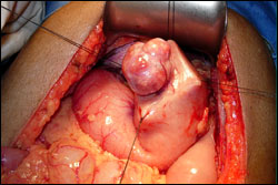 Bypass Gastric Surgery