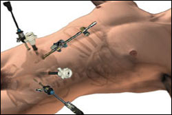 Laparoscopic surgery