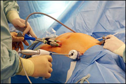 Laparoscopic surgery