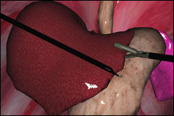 Advanced Laparoscopic Surgery