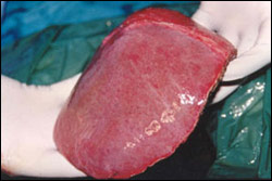 Liver Surgery