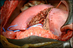 Liver surgery