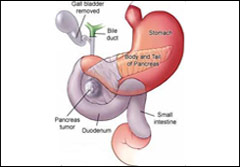 Pancreatic Surgery