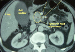 Pancreatic Surgery