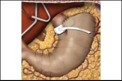 Sleeve gastrectomy