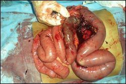 Small Bowel Obstruction Surgery